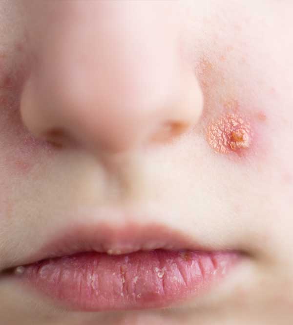 Impetigo