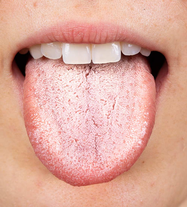 Oral Thrush