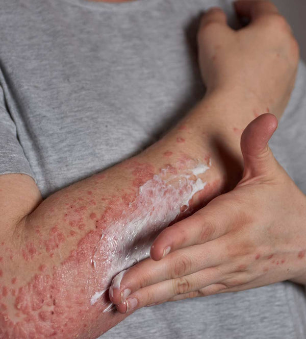 Shingles